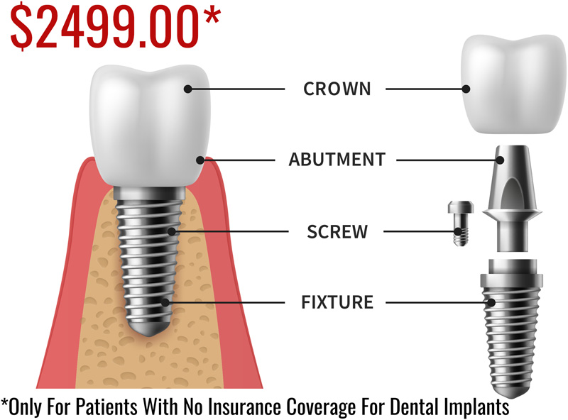 Dental Implants in Cranberry Township, PA Dentist 16066